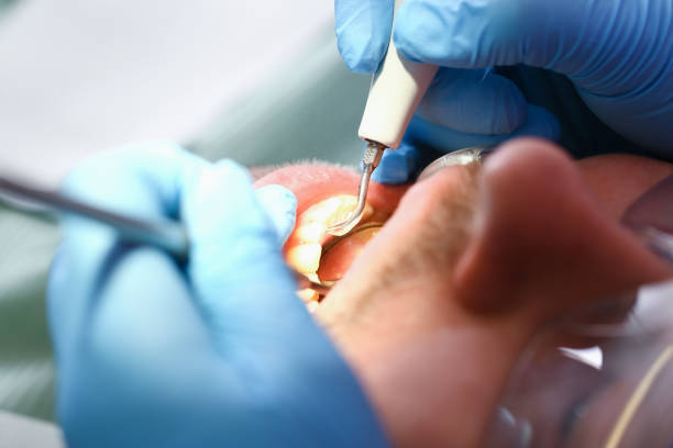 Best Chipped Tooth Repair Near Me  in Scottdale, GA